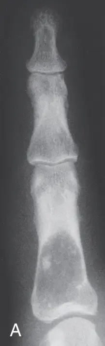 Encondroma na falange proximal