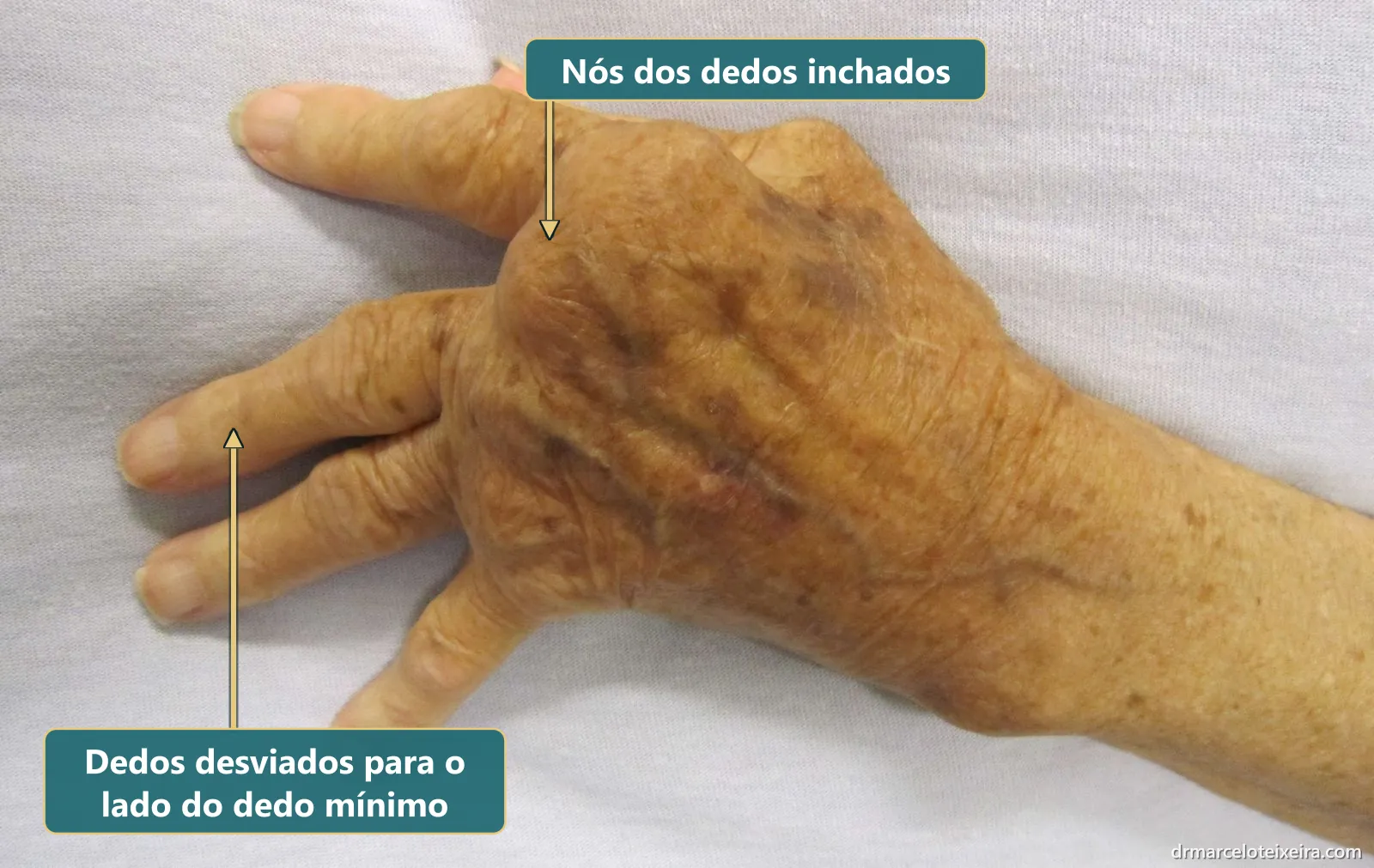 Artrite reumatoide na mão: dedos desviados para o lado do dedo mínimo e nós dos dedos inchados