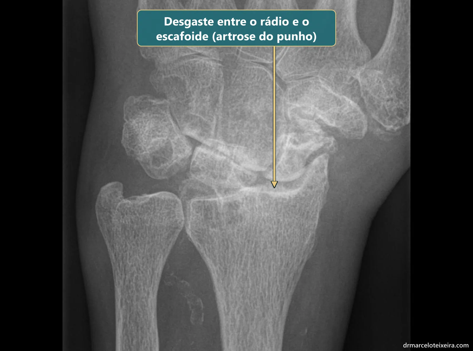 Raio-X de artrose do punho: desgaste da cartilagem entre o rádio e o escafoide