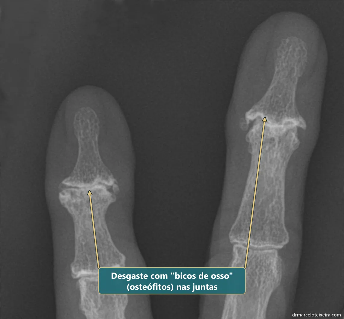 Raio-X de artrose dos dedos: osteófitos e desgaste nas articulações da ponta dos dedos (nódulos de Heberden)
