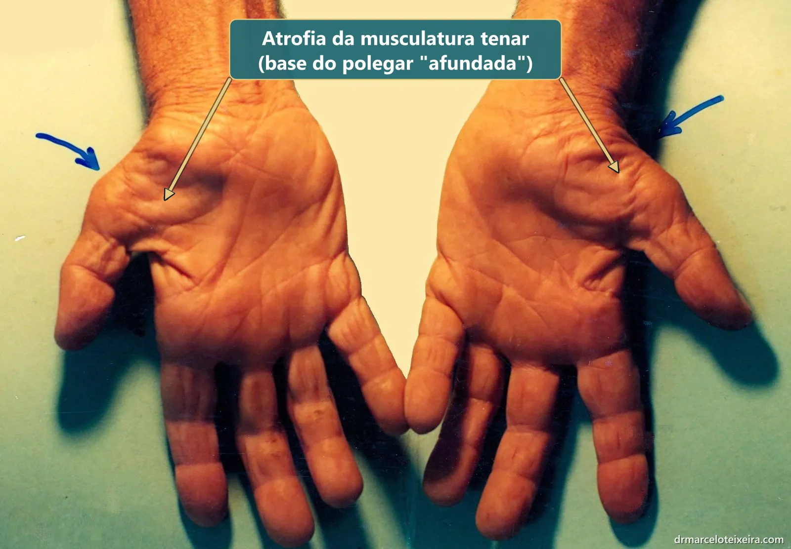 Atrofia da musculatura tenar nas duas mãos: a base do polegar fica afundada na síndrome do túnel do carpo avançada