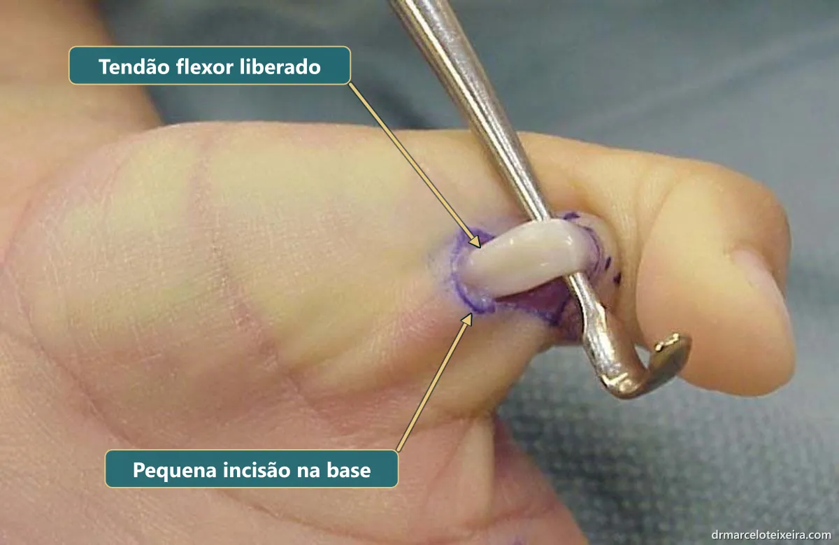 Cirurgia do dedo em gatilho: tendão flexor liberado após abertura da polia A1 por uma pequena incisão