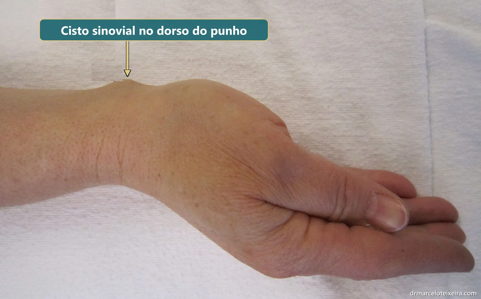 Cisto sinovial no dorso do punho visto de lado: caroço sob a pele em cima do punho