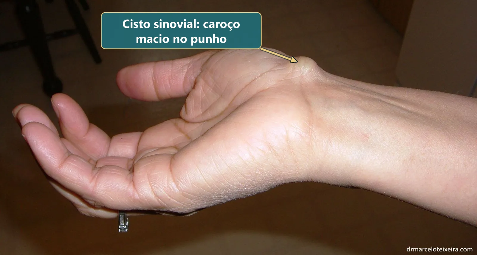 Cisto sinovial no punho: caroço arredondado na face palmar do punho, perto da base do polegar