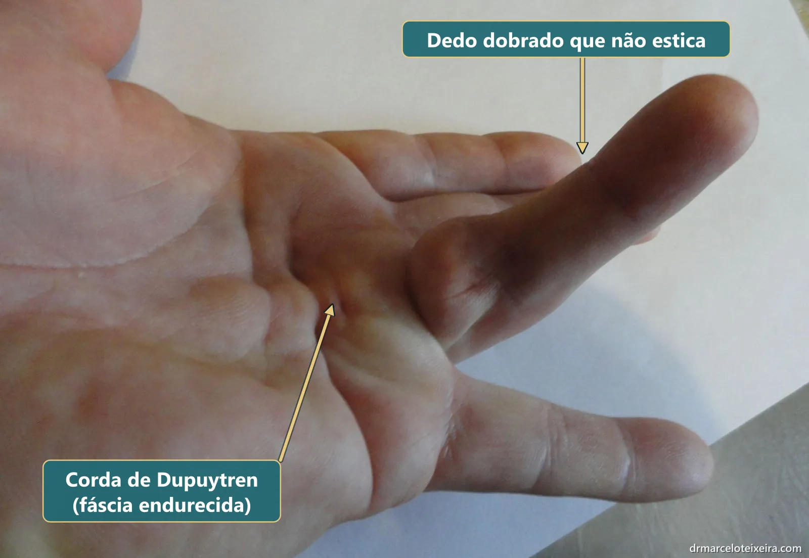 Contratura de Dupuytren: corda endurecida na palma da mão puxando o dedo para dentro, sem conseguir esticar