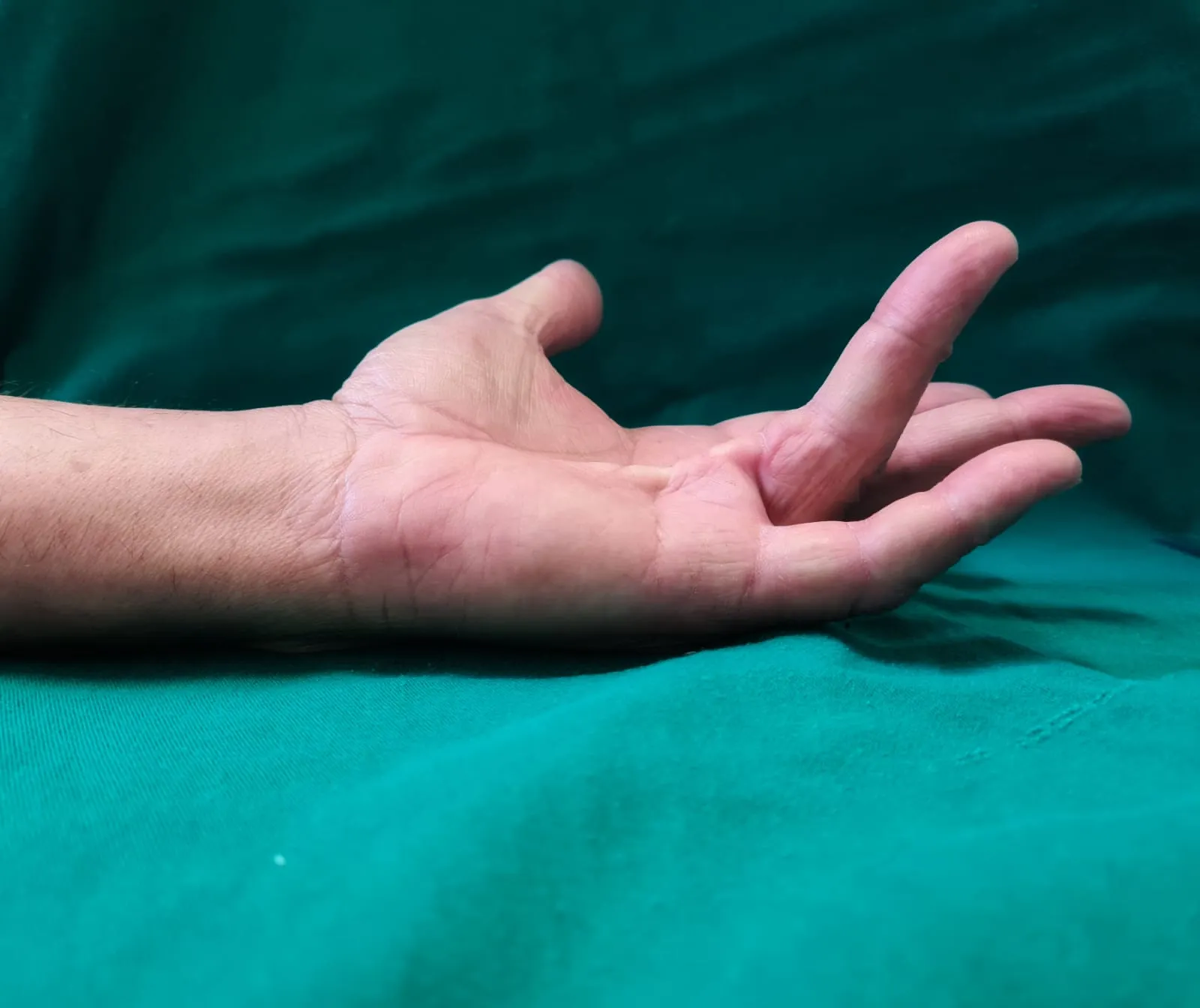 Contratura de Dupuytren: dedo que não estica mais, puxado por uma corda de tecido fibroso na palma da mão