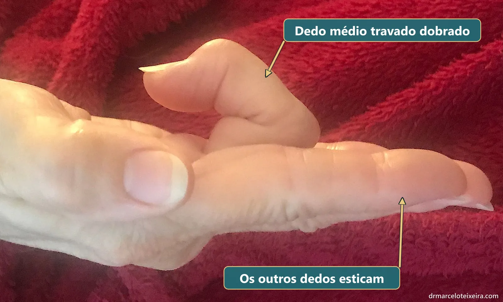 Dedo em gatilho: dedo médio travado dobrado enquanto os outros dedos ficam esticados