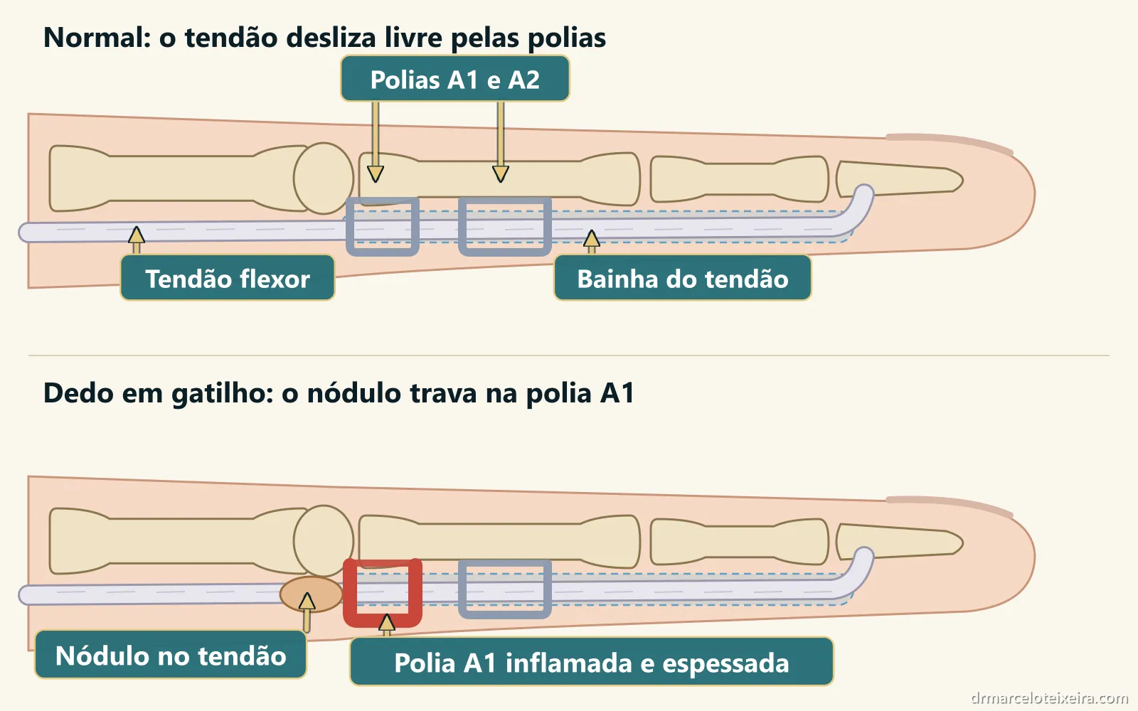 Diagrama do dedo em gatilho: nódulo no tendão flexor travando na polia A1 inflamada, comparado ao dedo normal