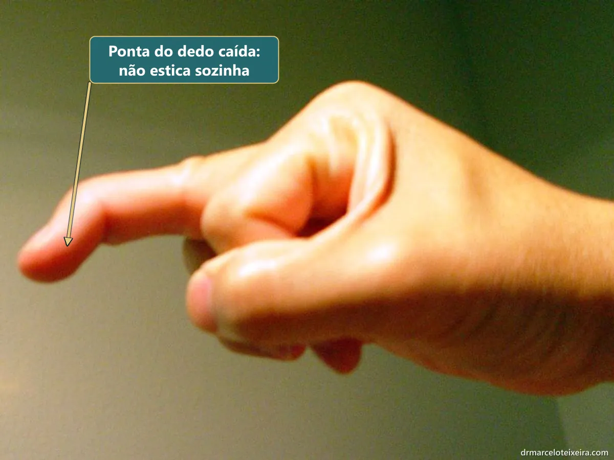 Dedo em martelo: ponta do dedo caída, sem conseguir esticar sozinha