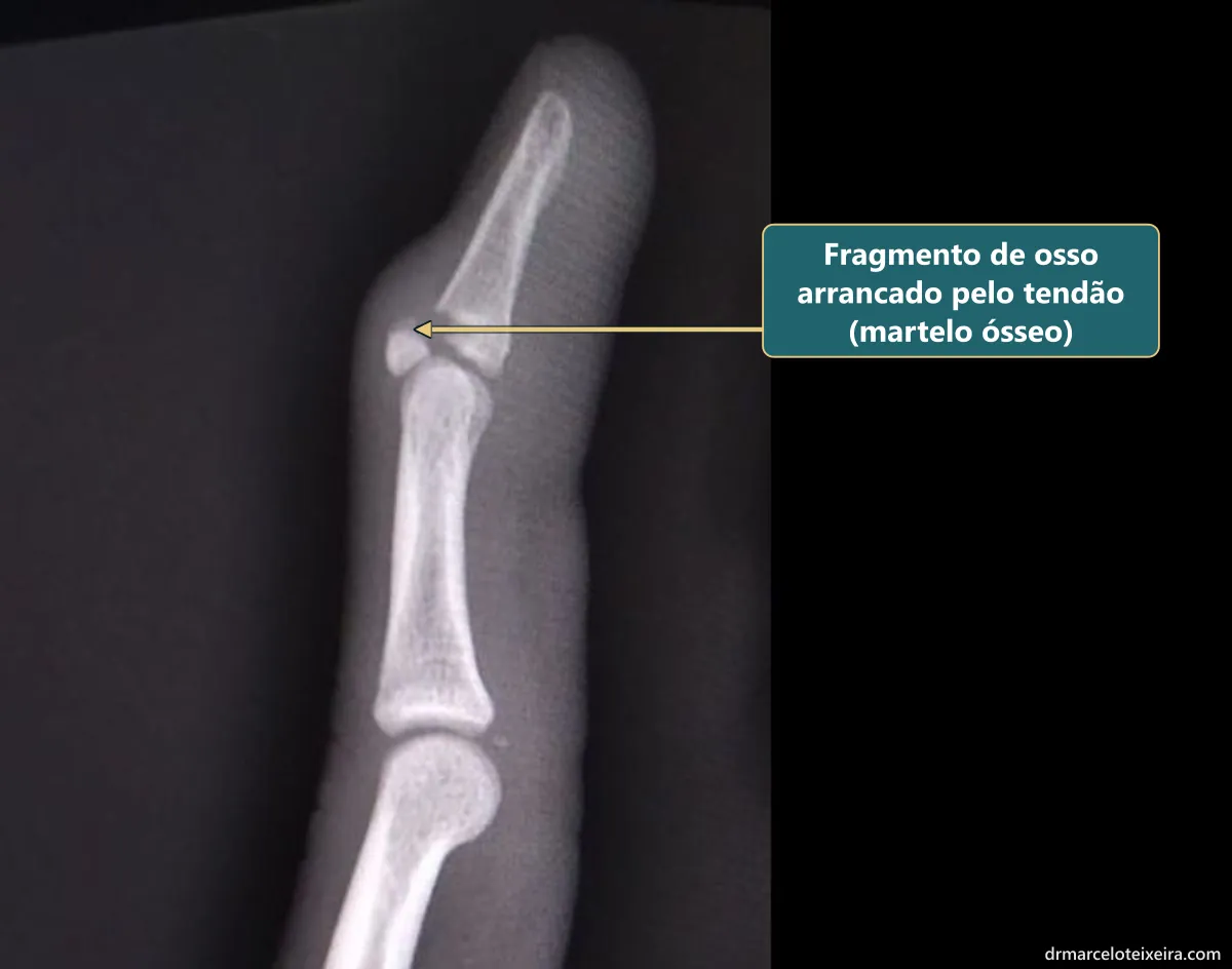 Raio-X de perfil do dedo em martelo ósseo: fragmento de osso arrancado pelo tendão extensor na base da falange distal