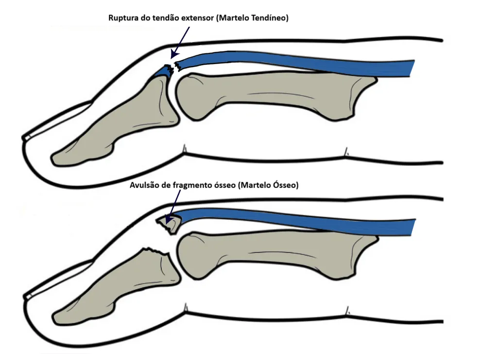 Dedo em martelo: ruptura do tendão extensor (martelo tendíneo) e avulsão de fragmento ósseo (martelo ósseo) na ponta do dedo