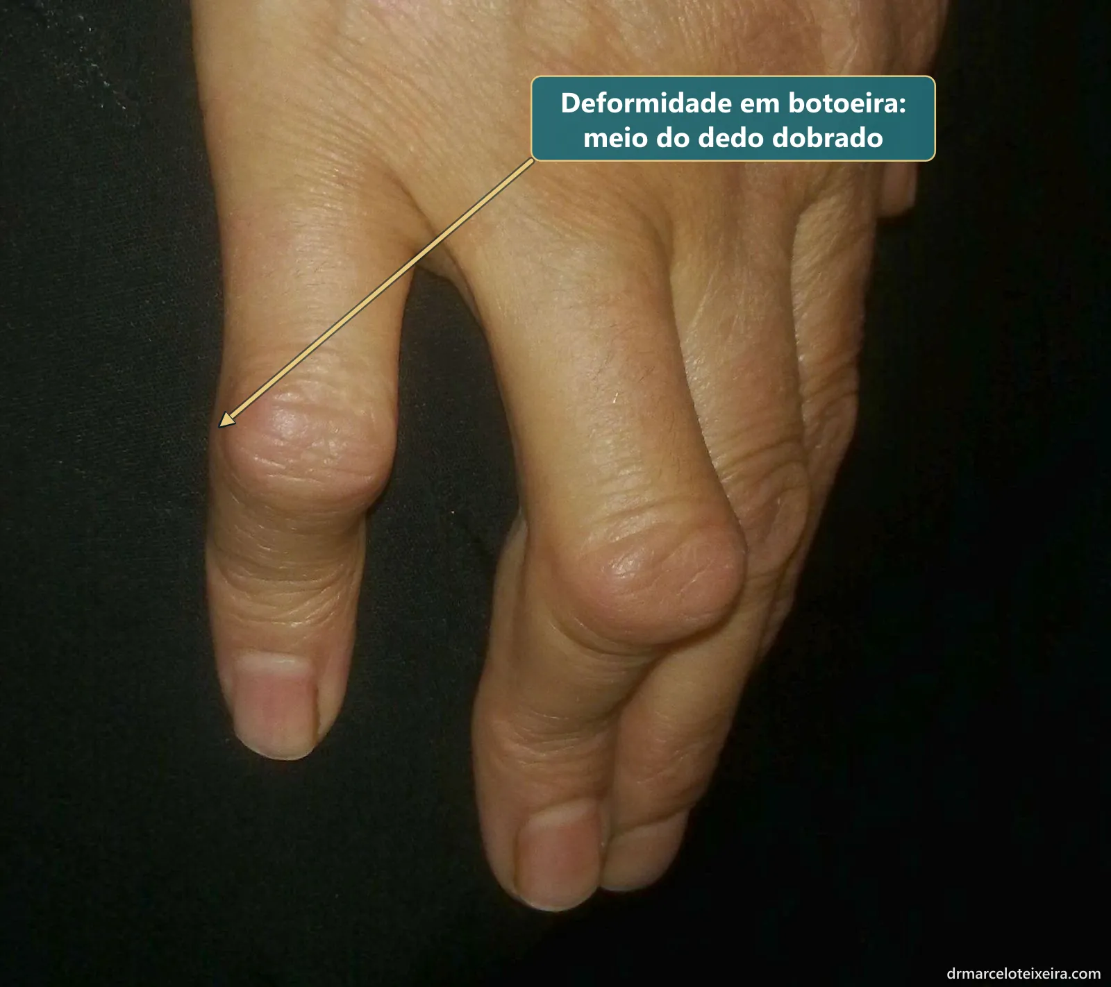 Deformidade em botoeira por lesão do tendão extensor: junta do meio do dedo dobrada e ponta esticada