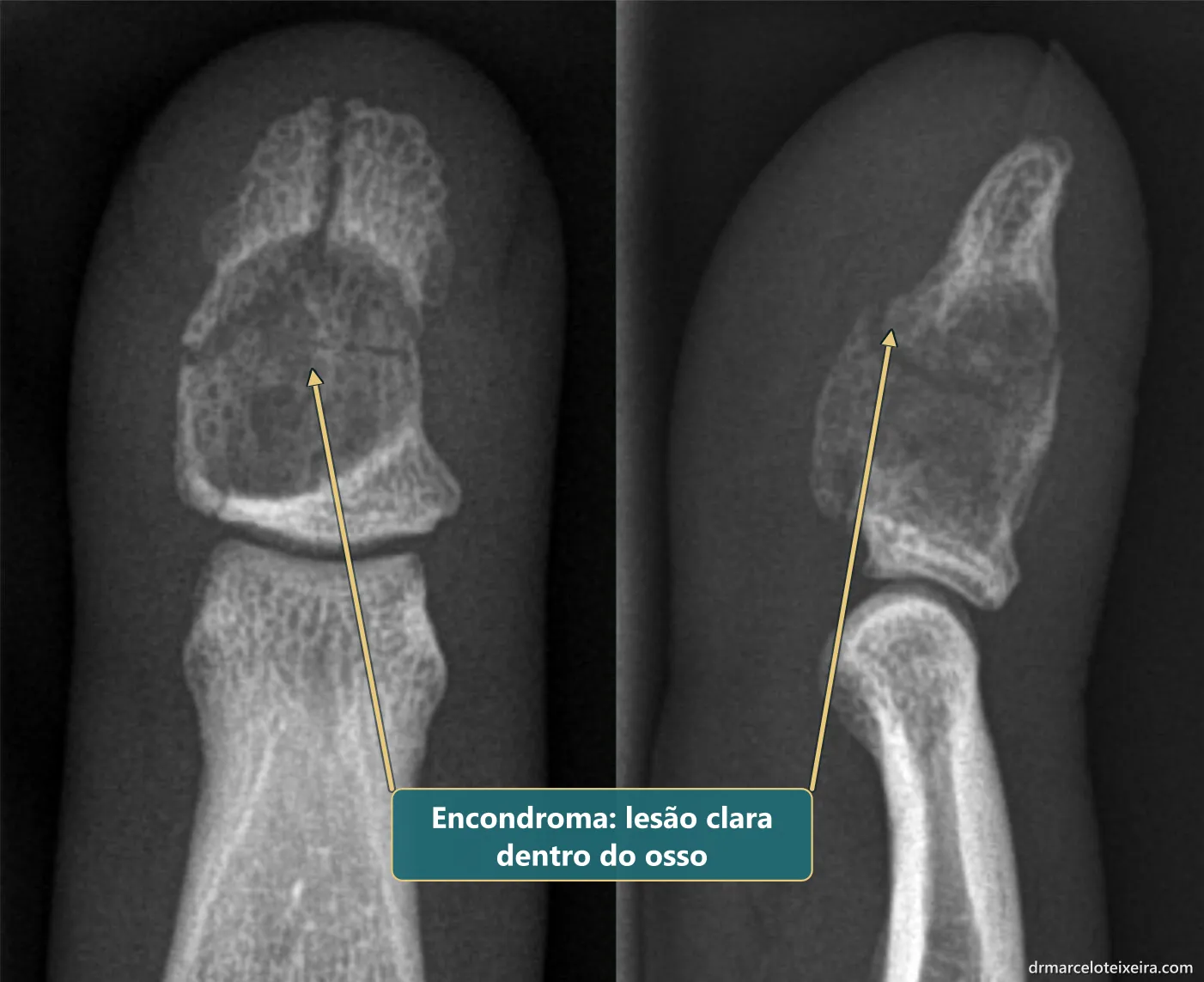 Raio-X de encondroma: lesão clara dentro do osso da ponta do dedo, de frente e de perfil, com fratura