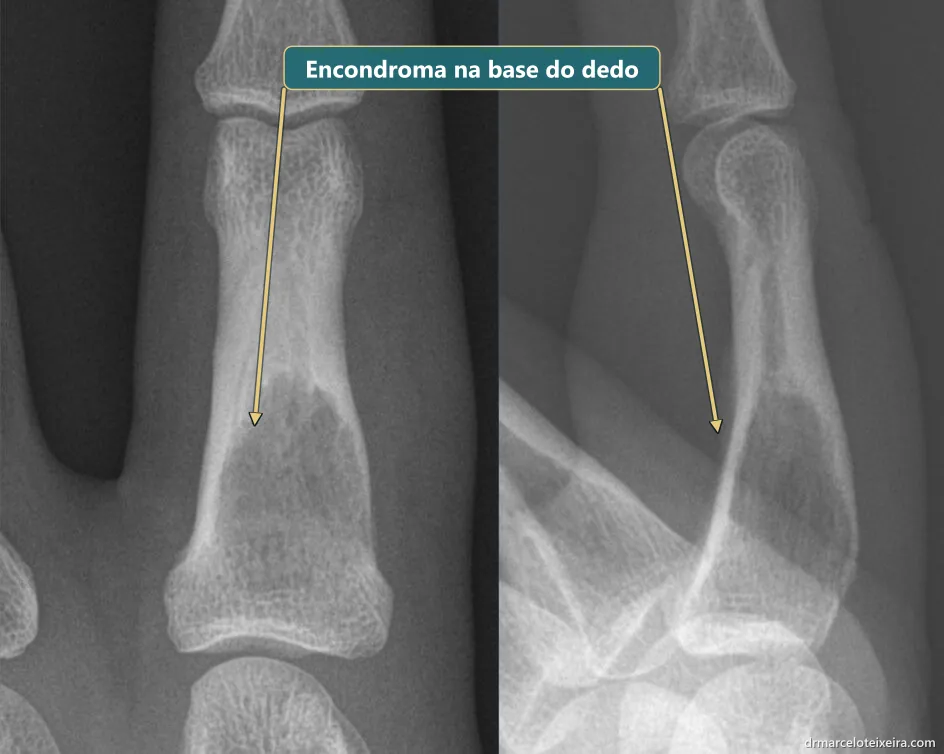 Raio-X de encondroma na base da falange proximal do dedo indicador