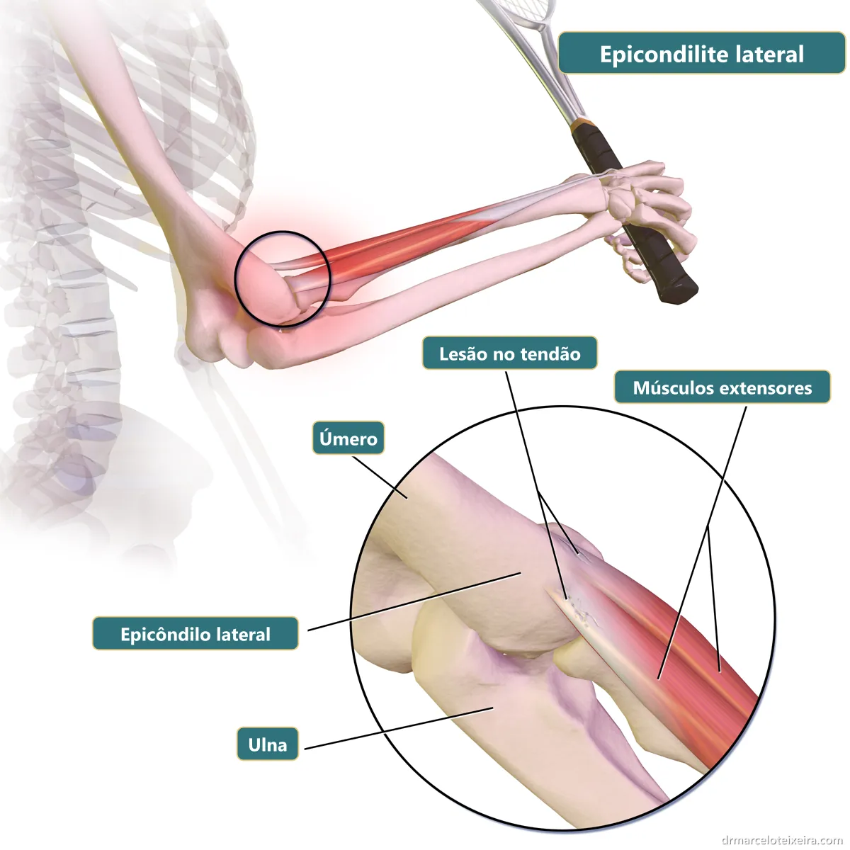 Anatomia da epicondilite lateral: lesão no tendão dos músculos extensores junto ao epicôndilo lateral do úmero