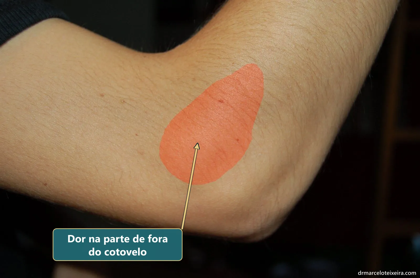 Epicondilite lateral (cotovelo de tenista): área de dor marcada na parte de fora do cotovelo