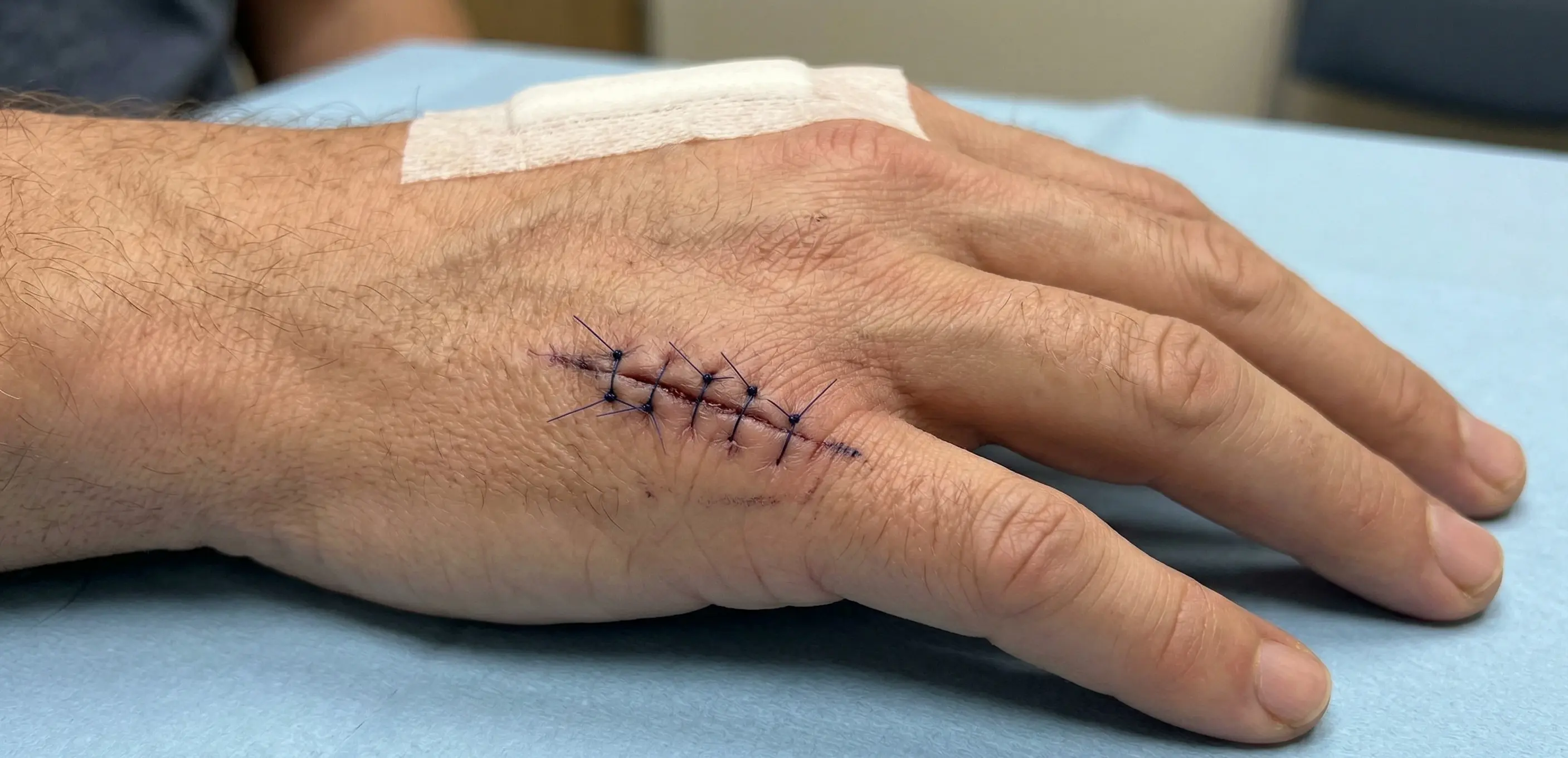 Lesão de tendão extensor da mão