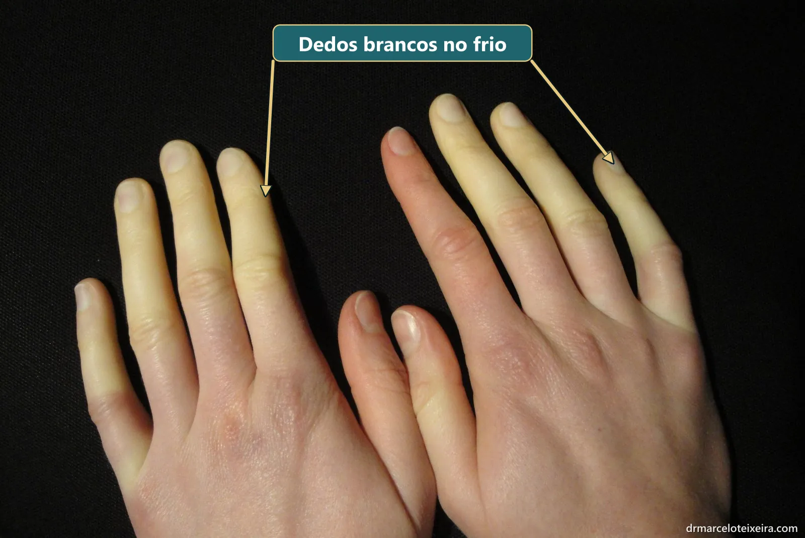 Fenômeno de Raynaud: dedos brancos, sem circulação, nas duas mãos durante uma crise de frio