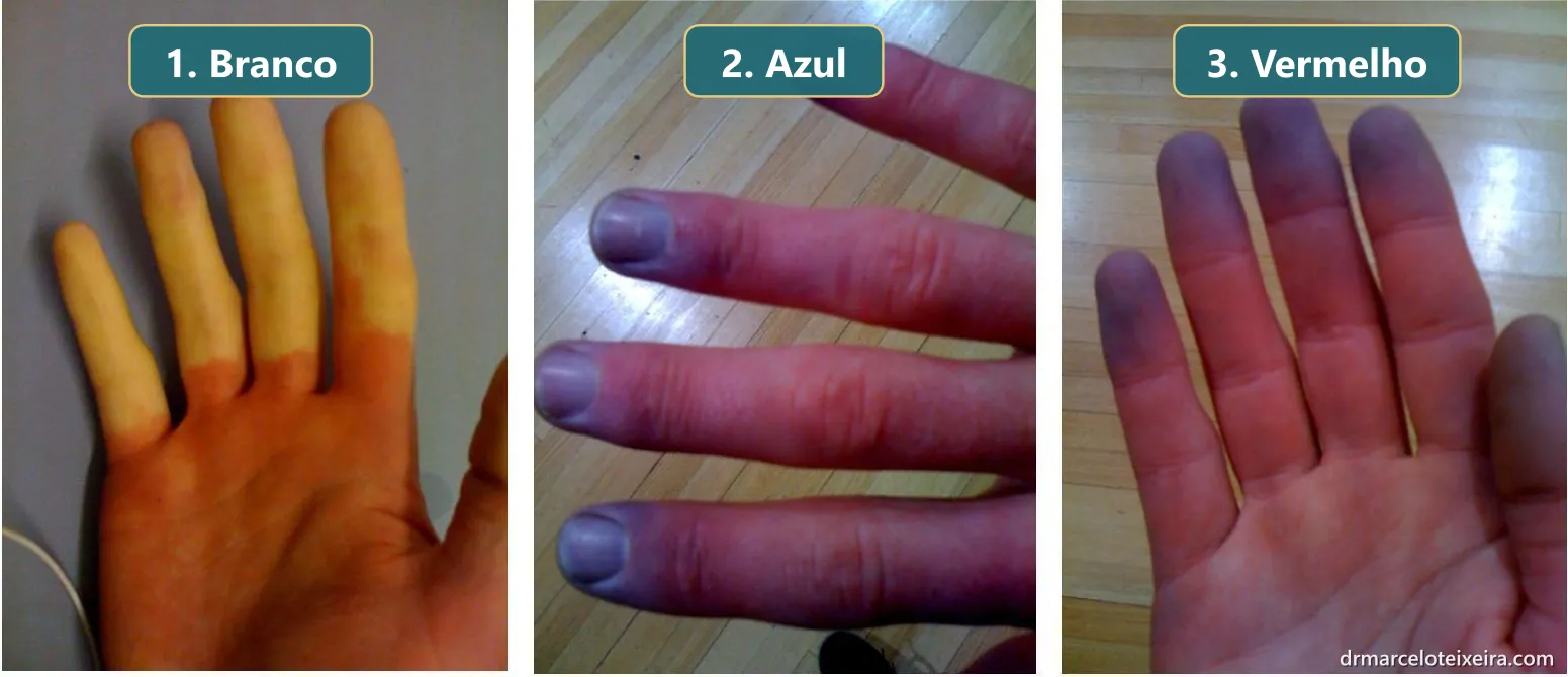 As três fases do fenômeno de Raynaud nos dedos: branco, azul e vermelho