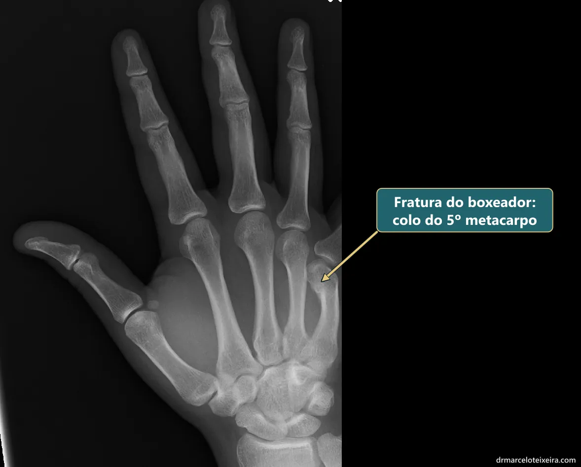 Raio-X de fratura do boxeador: fratura do colo do quinto metacarpo, abaixo do nó do dedo mínimo