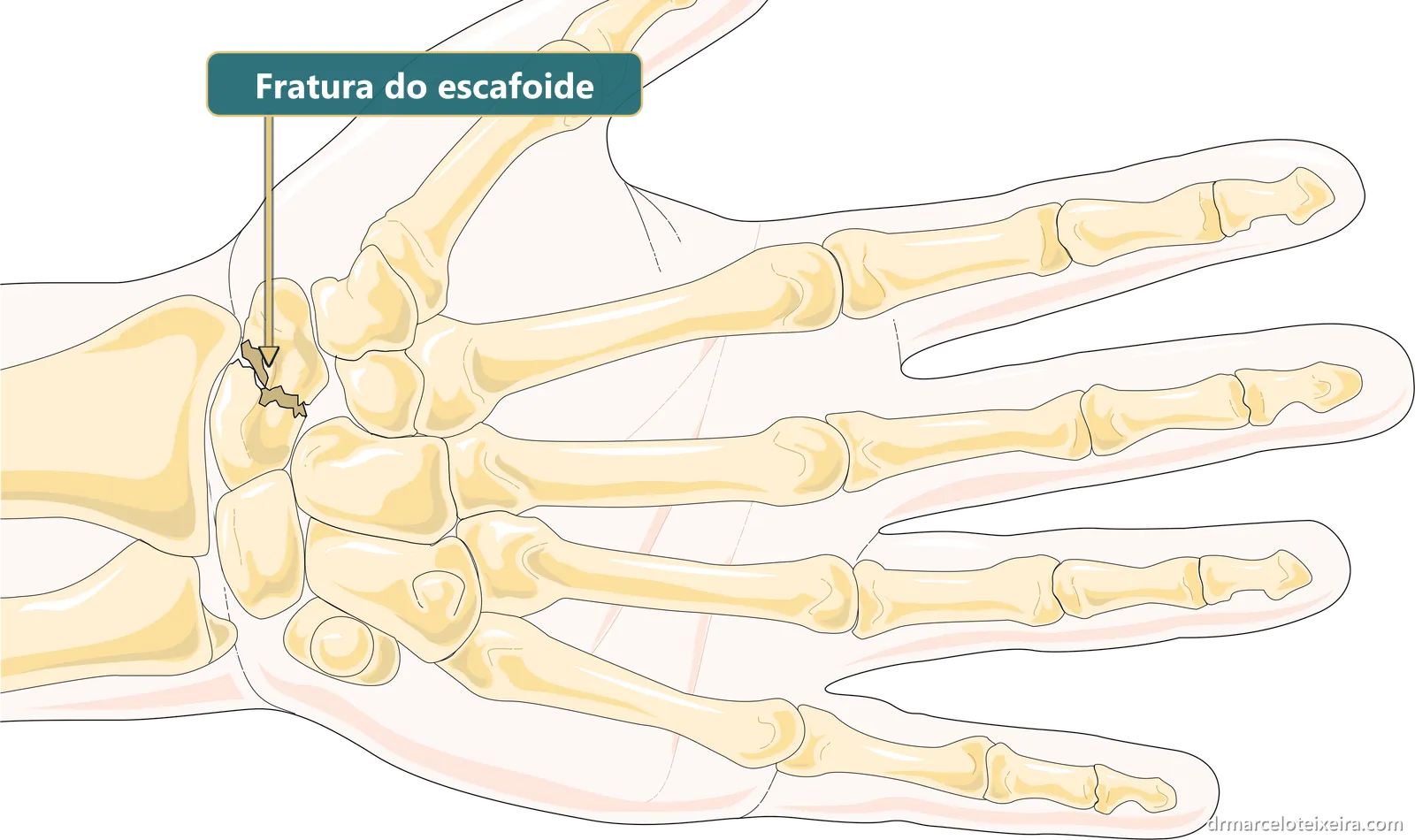Ilustração de fratura do escafoide: traço de fratura no osso escafoide, entre o rádio e a base do polegar