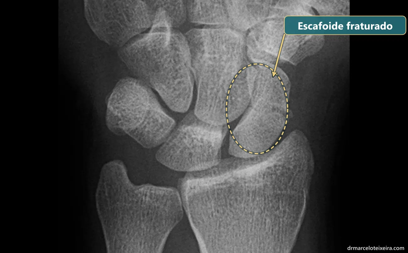 Raio-X de fratura do escafoide no punho, com o osso escafoide destacado