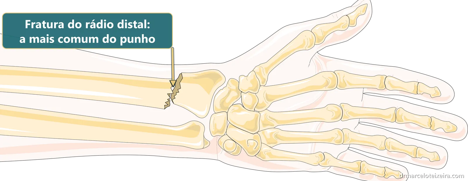 Ilustração de fratura do punho: traço de fratura no rádio distal, logo acima da articulação do punho