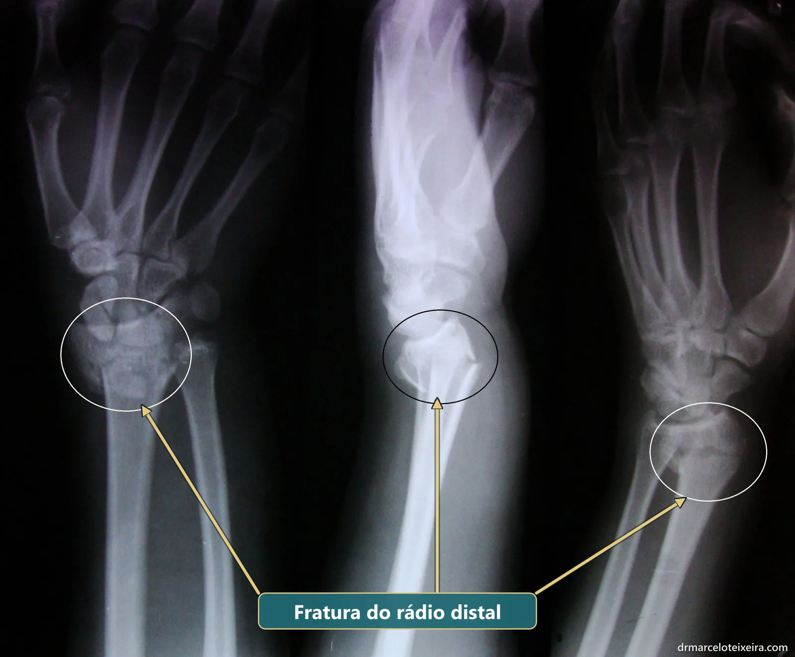 Raio-X de fratura do rádio distal (fratura de Colles) em três incidências, com a fratura circulada