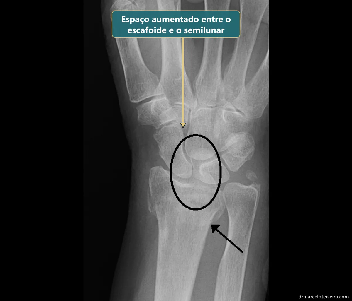 Raio-X de lesão escafossemilunar: espaço aumentado entre os ossos escafoide e semilunar do punho