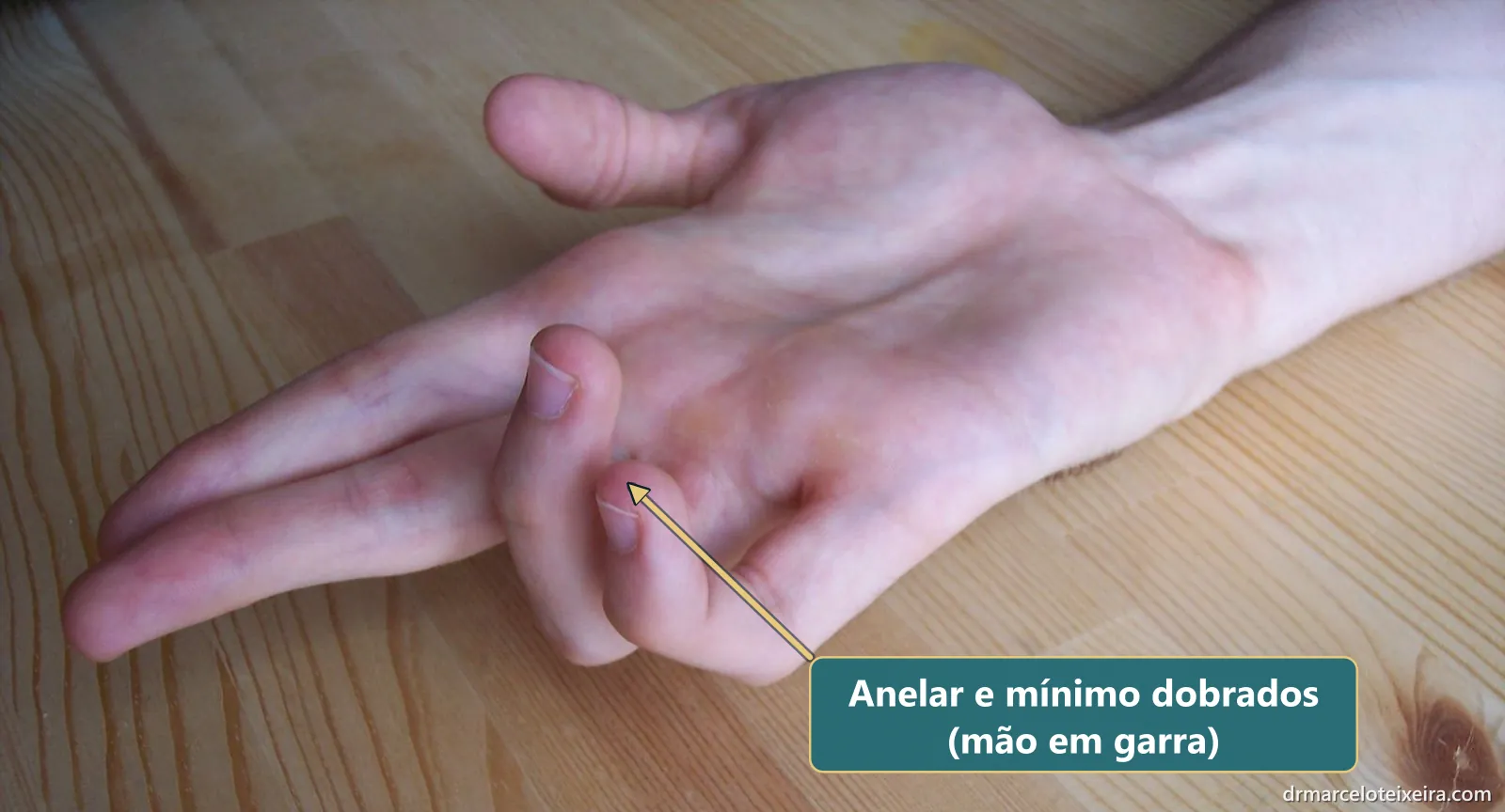Mão em garra na síndrome do túnel cubital: dedos anelar e mínimo dobrados por fraqueza do nervo ulnar