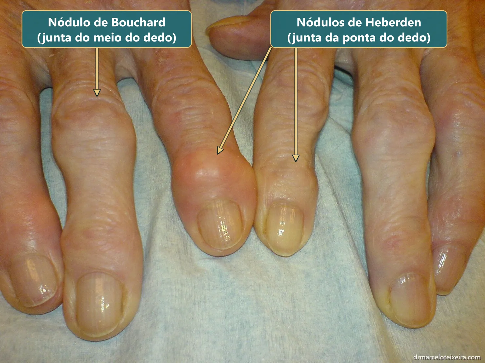 Artrose dos dedos: nódulos de Heberden nas juntas da ponta dos dedos e nódulo de Bouchard na junta do meio