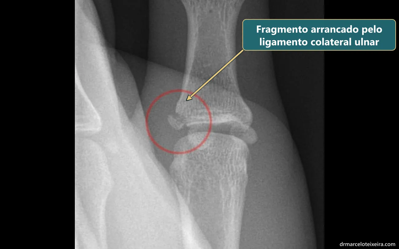 Raio-X do polegar do esquiador: fragmento ósseo arrancado pelo ligamento colateral ulnar na base do polegar