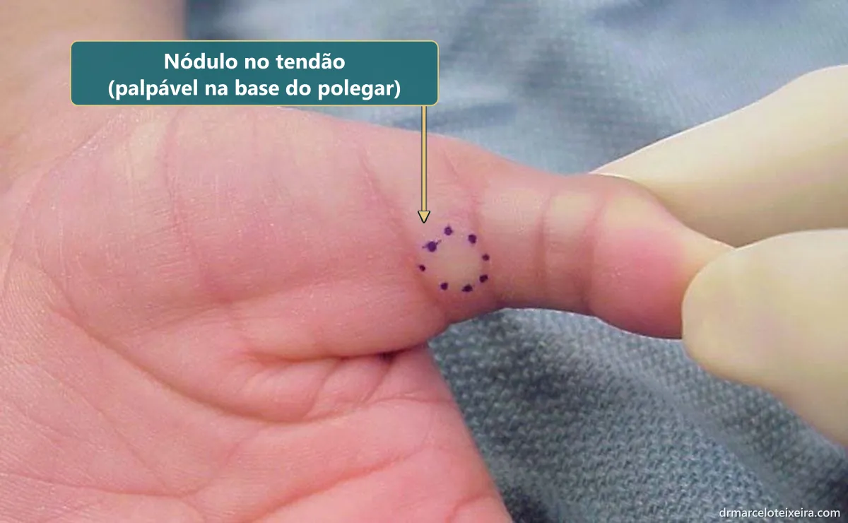 Nódulo palpável na base do polegar em gatilho, marcado com caneta na prega da pele