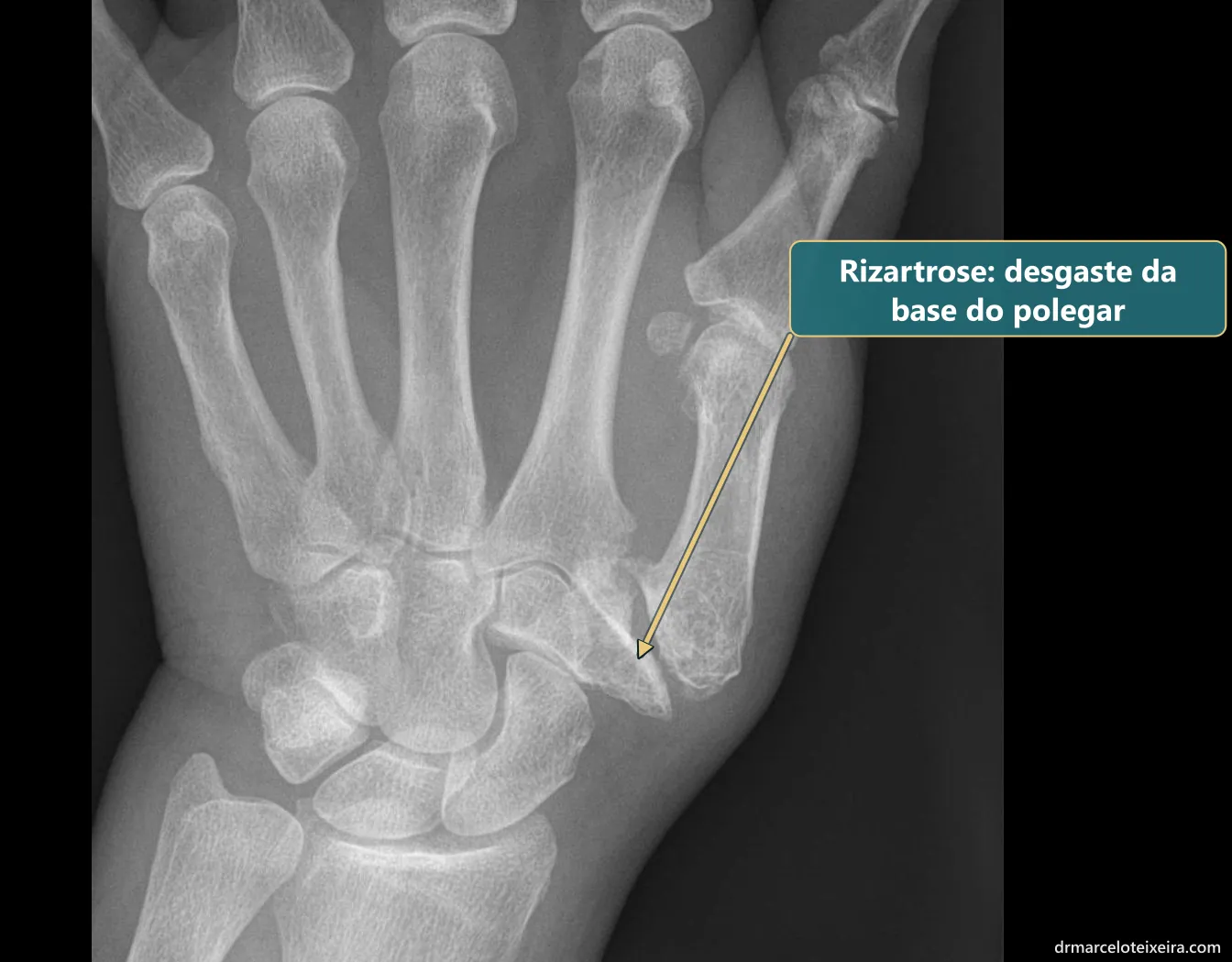 Raio-X de rizartrose: desgaste e deformidade da articulação trapézio-metacarpal, na base do polegar