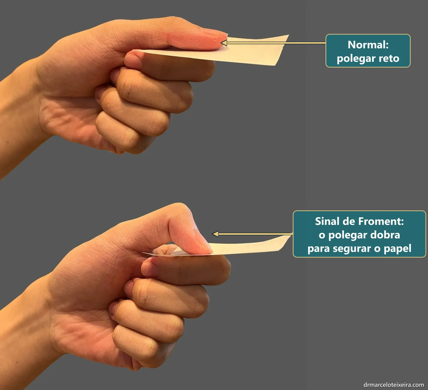 Sinal de Froment: ao segurar um papel entre o polegar e o indicador, o polegar dobra por fraqueza do nervo ulnar