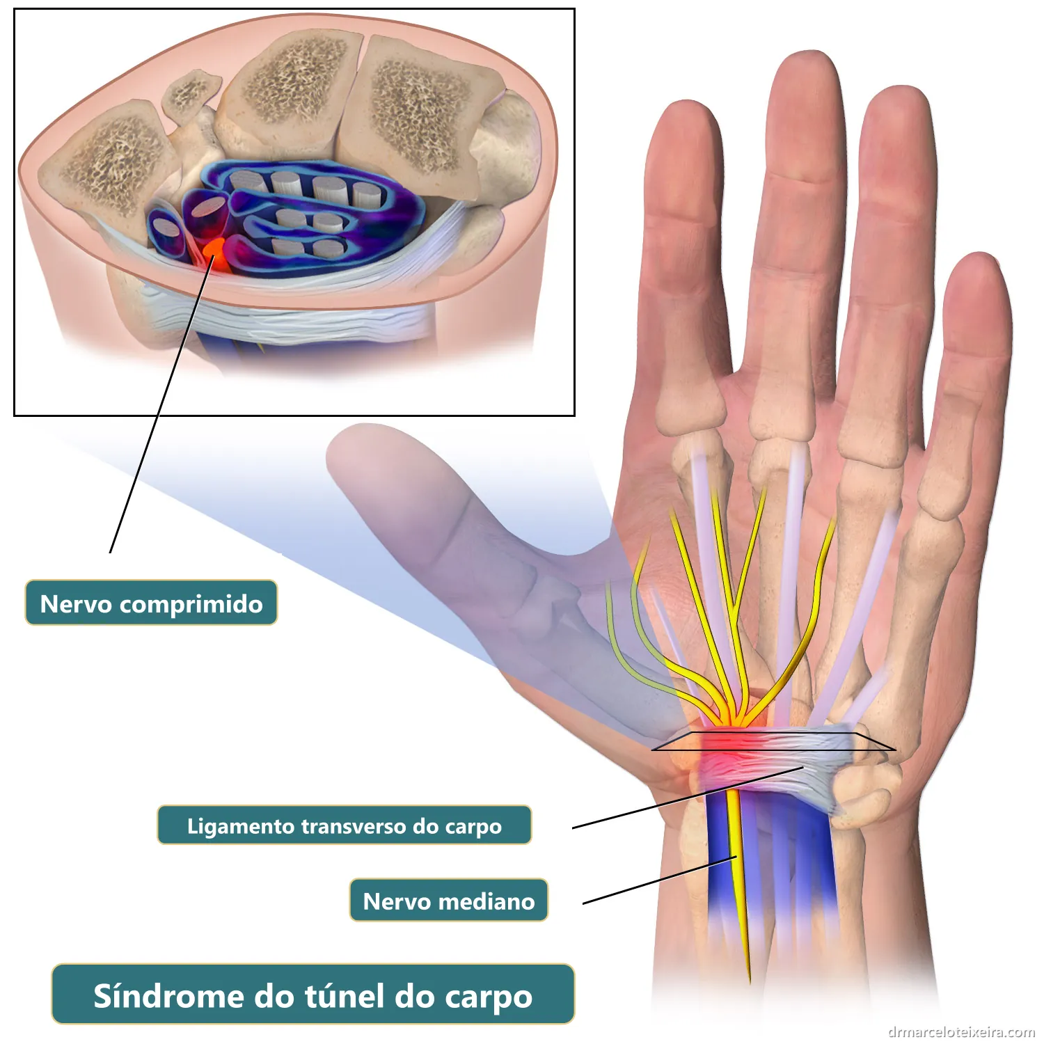 Síndrome do túnel do carpo: nervo mediano comprimido pelo ligamento transverso do carpo no punho, com corte mostrando o túnel