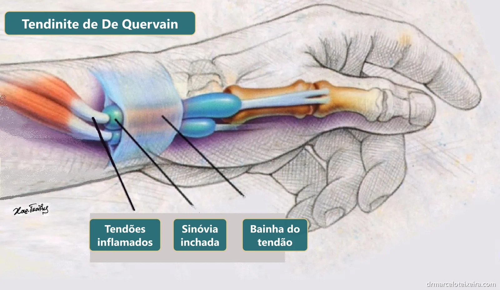 Anatomia da tendinite de De Quervain: tendões do polegar inflamados e bainha inchada no punho