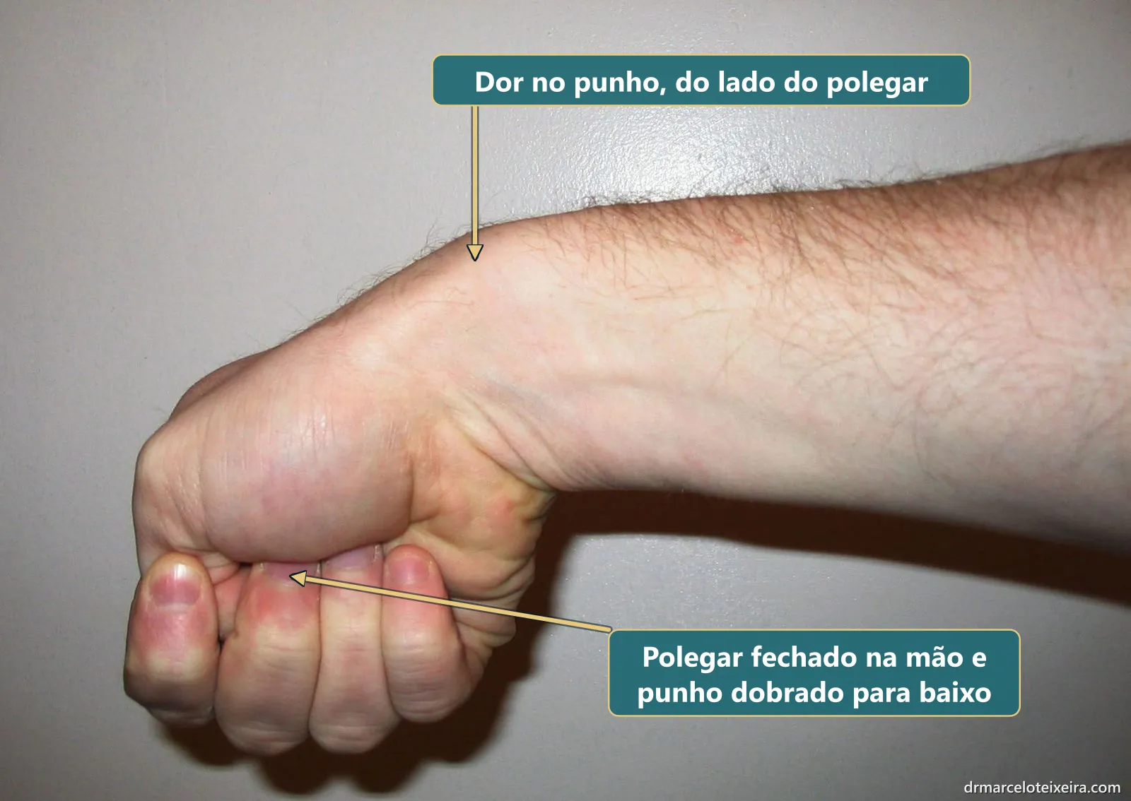 Tendinite de De Quervain: local da dor no punho, do lado do polegar, ao fechar o polegar na mão e dobrar o punho