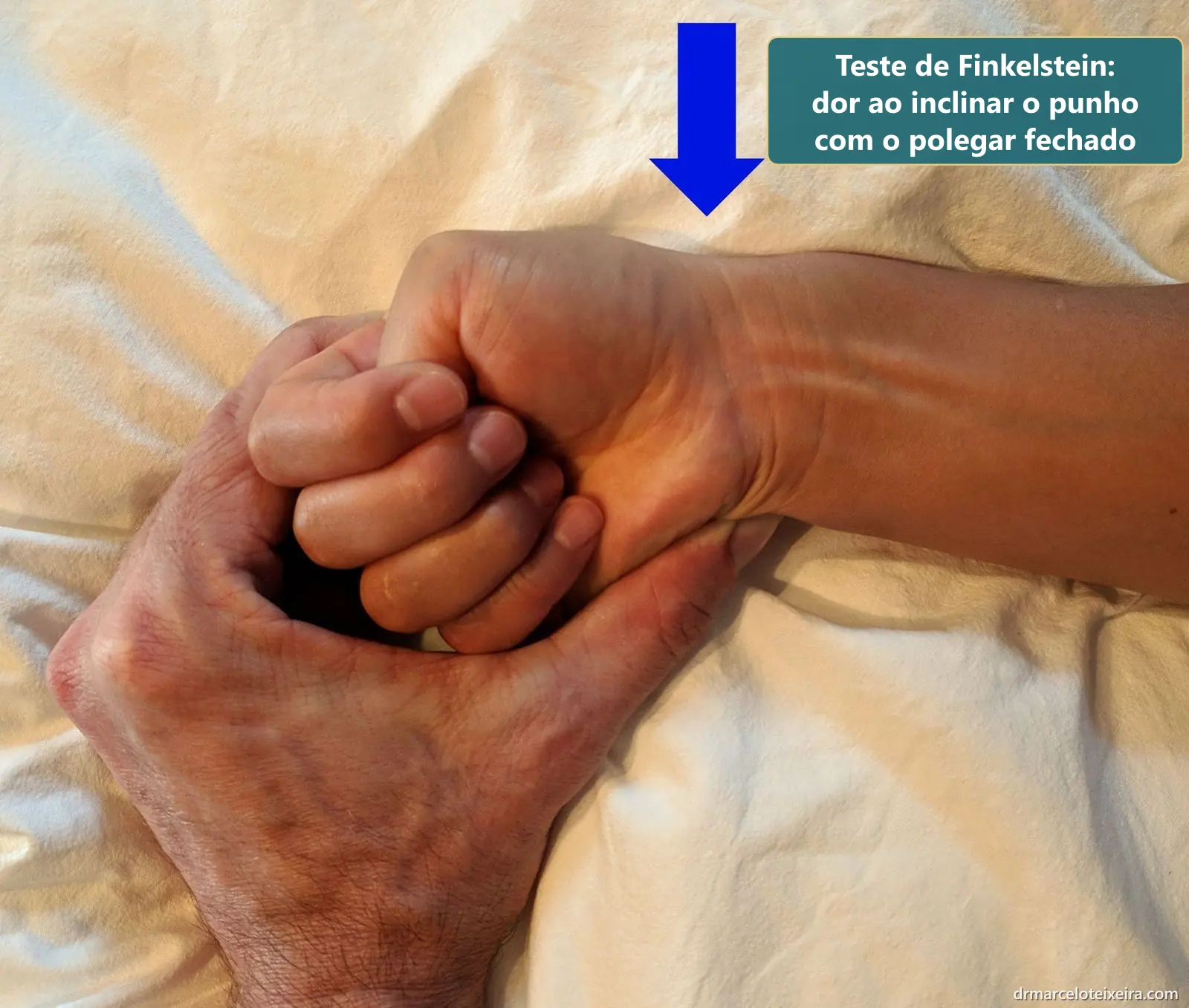 Teste de Finkelstein para tendinite de De Quervain: examinador inclina o punho do paciente com o polegar fechado