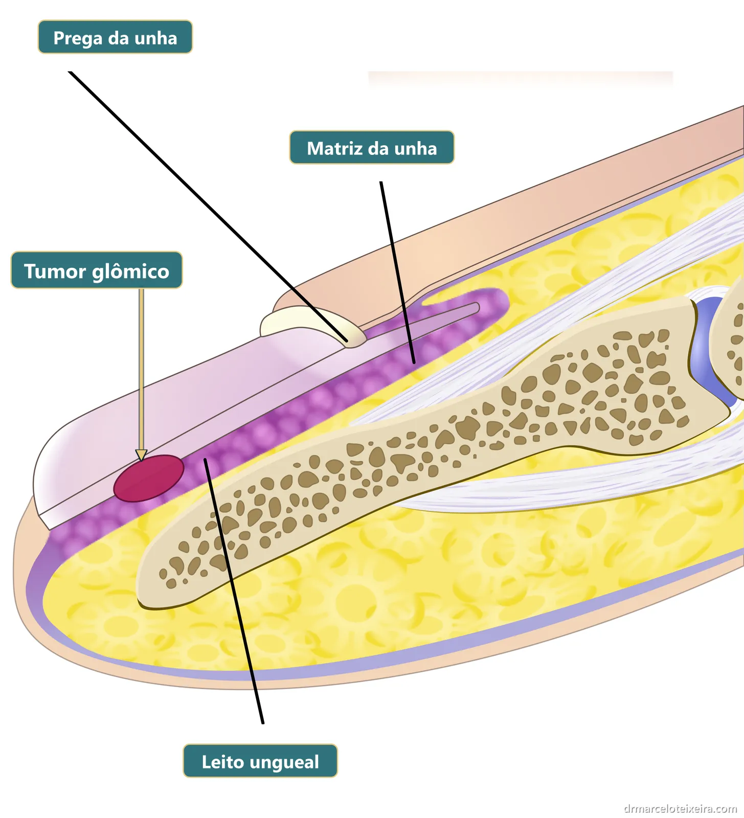 Anatomia do tumor glômico: pequeno tumor no leito da unha, entre a unha e o osso da ponta do dedo